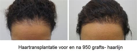 De Effectiviteit Van Haartransplantatie Bij Genetisch Haarverlies