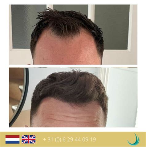 Haartransplantatie DHI: Een Persoonlijke Reis