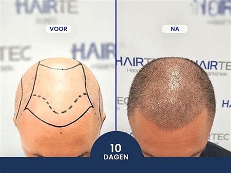 Haartransplantatie Kosten: Wat Zeggen De Statistieken?