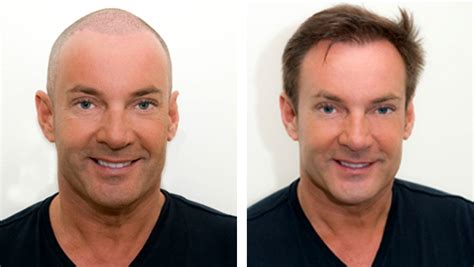Haartransplantatie Voor En Na: Visualisatie Van Resultaten
