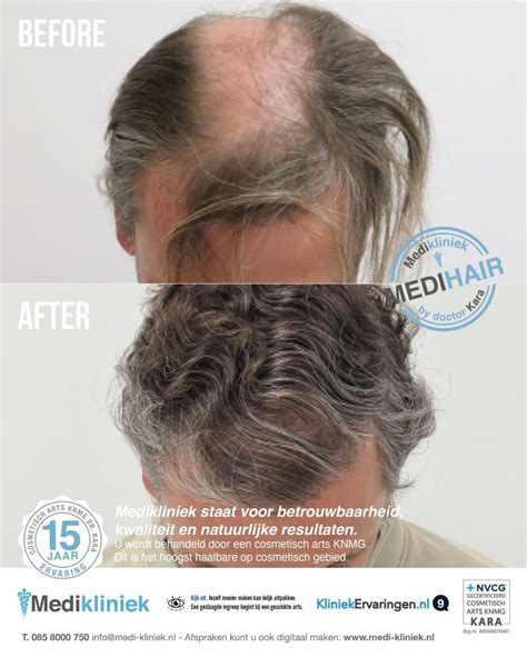 Kan Haartransplantatie Ook Bij Dunner Wordend Haar Helpen?