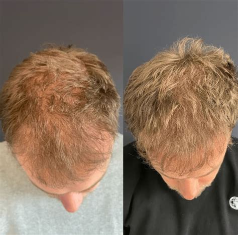 Kom Jij In Aanmerking Voor Haartransplantatie?