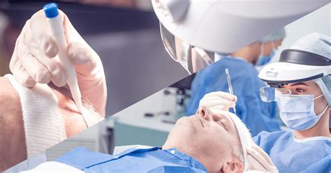 Saffier FUE Vs. Andere Haartransplantatietechnieken